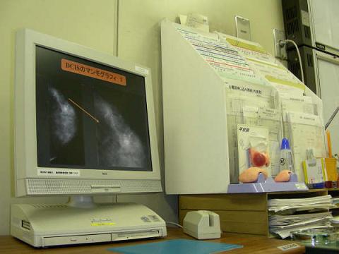 診察室のパソコンで検査方法などについて説明。マンモグラフィーでみられる石灰化像を示す。