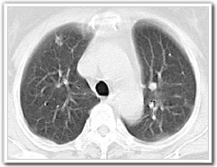 肺がんCT検診画像