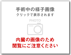 手術中の様子。術者には3Ｄ画像として見える