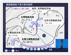 図．腹腔鏡補助下胃分節切除術