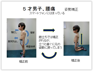 図版８. ５歳男子、腰痛で来院