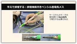 手元で排煙する：排煙機能付きペンシル型電気メス