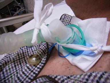 気管カニューレと回路のずれ防止。接続部分を綿紐で結わえている（都立神経病院提供）