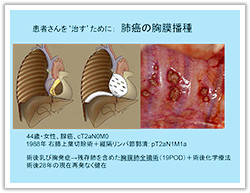 肺癌の胸膜播種