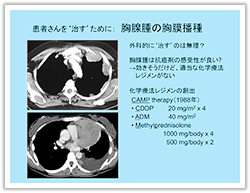 肺腺腫の胸膜播種