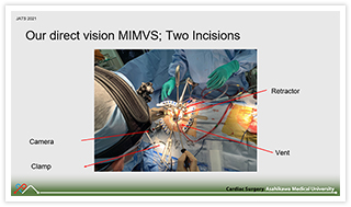 直視下における低侵襲僧帽弁手術