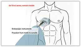 胸腔内における器具の動き
